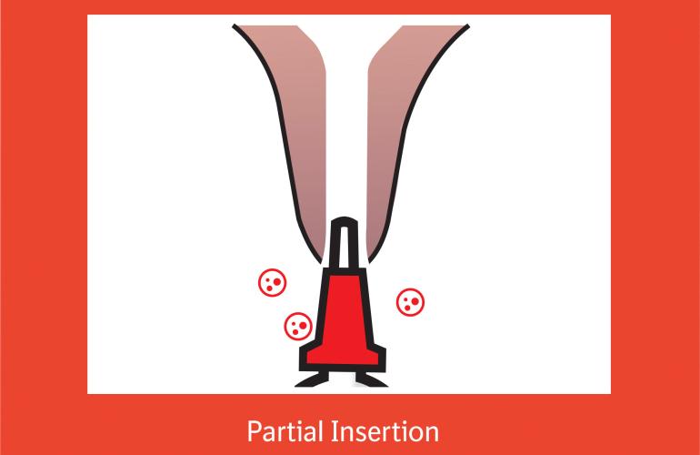Dry-Clox Partial Insertion graphic