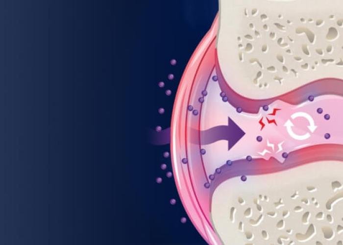 Image showing an illustration of inflammation in a joint