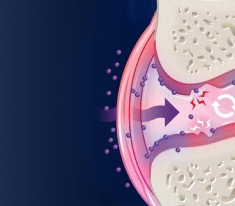 Image showing an illustration of inflammation in a joint